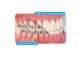 Tooth Tone® beschichtete Nickel-Titan-Drahtbögen - Full-Form, rechteckig, geätzt UK, .018" x .018"